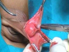 Male genital enlargement surgery