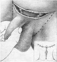 Surgical lengthening of the penis by removing the private part